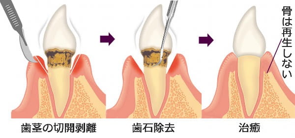 フラップ手術（歯周外科）