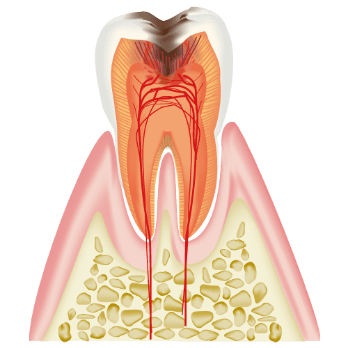 C3（歯髄に達した虫歯）