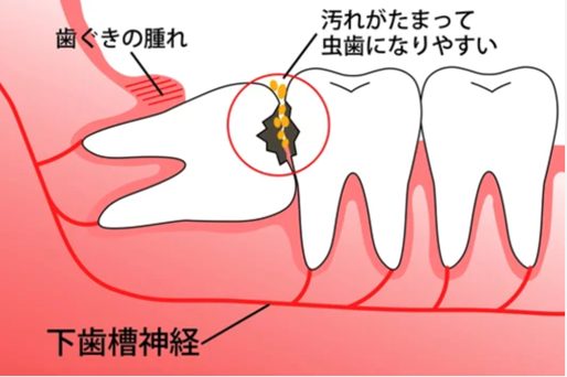 親知らずの抜歯